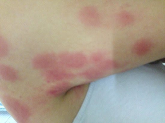 Itchy rash on arm caused by bed bug bites (Yaru H, mai 2014)