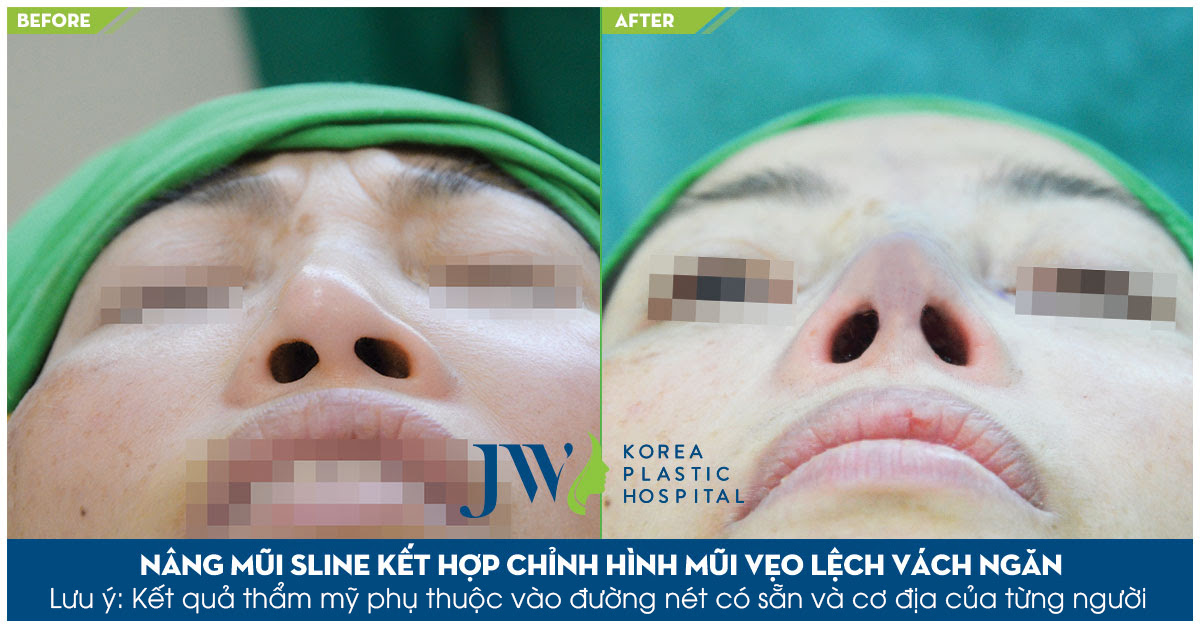 Mũi hỏng sau nâng mũi S Line