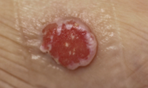 皮ふがん 悪性腫瘍 すがも小林皮フ科