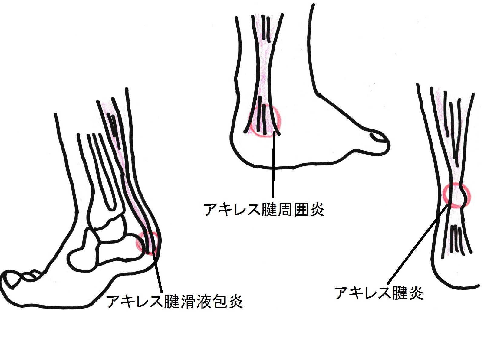アキレス腱炎 周囲炎 アスリートゴリラ鍼灸接骨院 旧高林はりきゅう接骨院