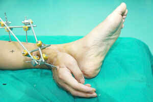 Chinese man's severed hand saved by attaching it to his ankle Chinese man's severed hand saved by attaching it to his ankle