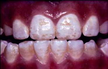 http://unlockyourminddotcom.files.wordpress.com/2012/08/pitted_teeth_-_moderate_fluorosis_small-uk-council-against-fluoridation.jpeg