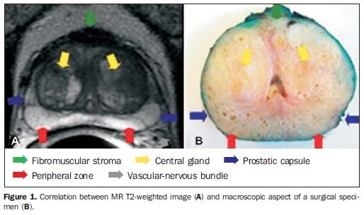 Prostate Cancer Diagnosis Psa Levels / Prostate biopsy surgery - Stock Video Clip - K003/1555 : About 1 in 35 men will die from it.