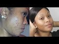 How to Get Rid of Dark Spots With 9 Easy Tips