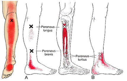 Douleur phlébite jambe