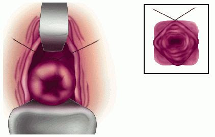 cerclage
