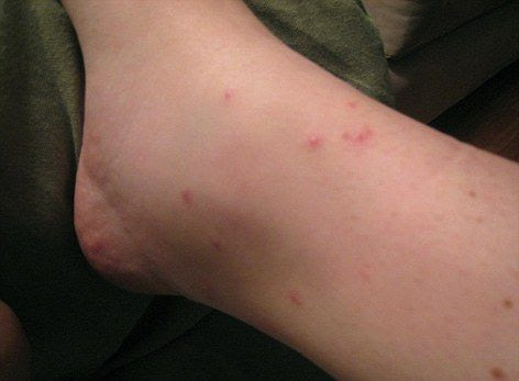 MAILONLINE.COM - A British Airways passenger badly bitten by 'bed bugs ...