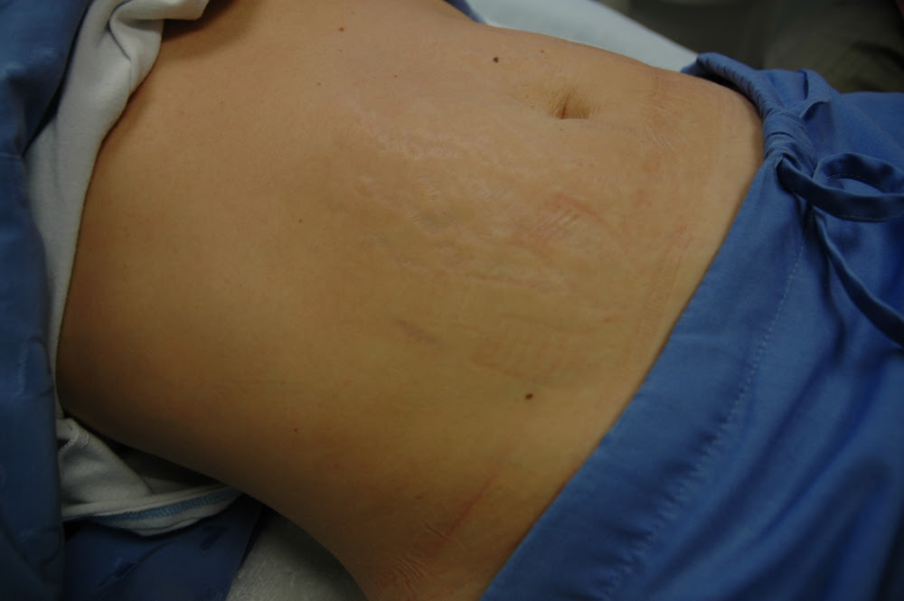 trattamento peeling