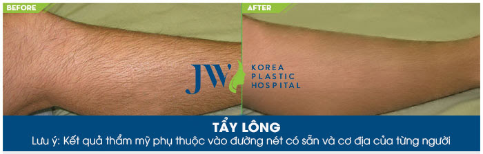Hình ảnh trước và sau khi sử dụng dịch vụ tẩy lông chân tại JW