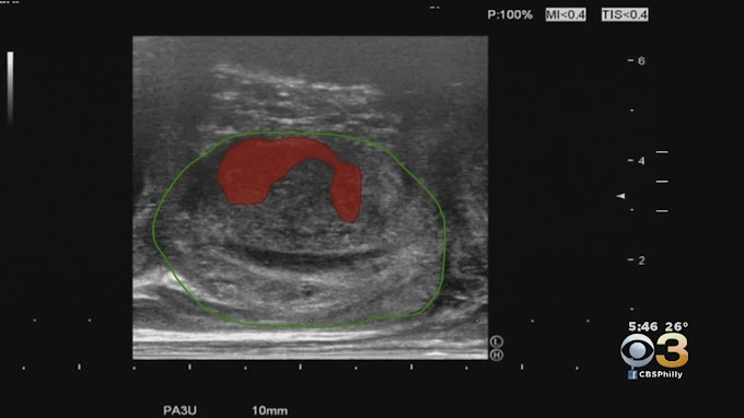 Prostate Cancer Statpearls / New Technology Improving Prostate Cancer Survival Rates With Earlier