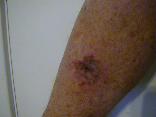 arm band tribal tattoos how much does laser tattoo removal cost