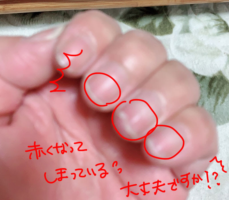 あわちゃん助けてー 爪がこんなことに ぐだぐだネイルスタジオ あわちゃんねるブログ