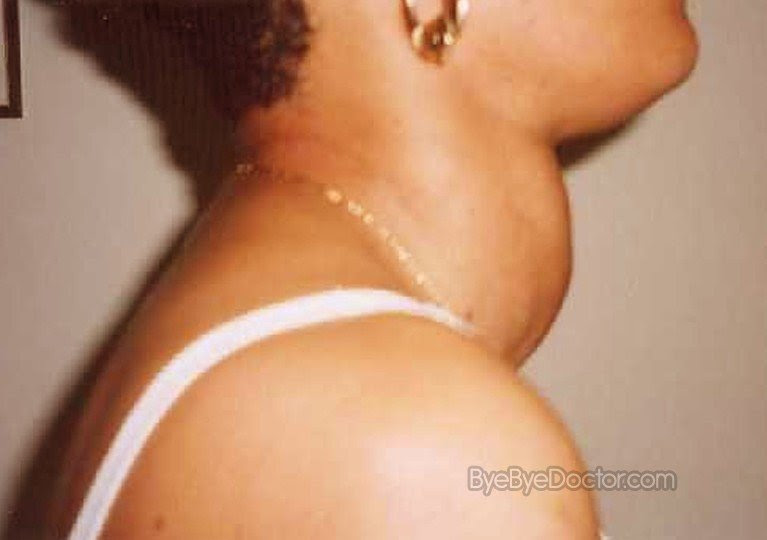 Goiter