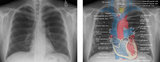 Anatomy Of Chest X Ray - X Thorax Startradiology - It first appears too complicated to read the chest xrays because we barely know what.