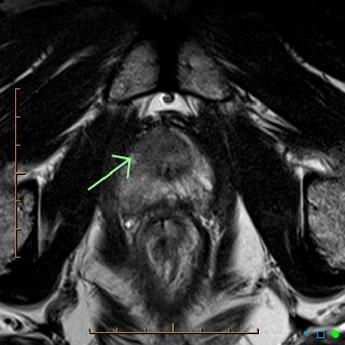 Prostate Cancer Symptoms In Dogs / Prostate cancer MRI - wikidoc
