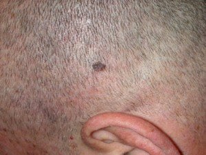 Skin Cancer Vs Melanoma - Â» One-eyed trucker with 15 yearsâ experience claims / Melanoma is a type of skin cancer that develops in the skin cells (melanocytes) responsible for producing the pigment that gives your skin color (melanin).