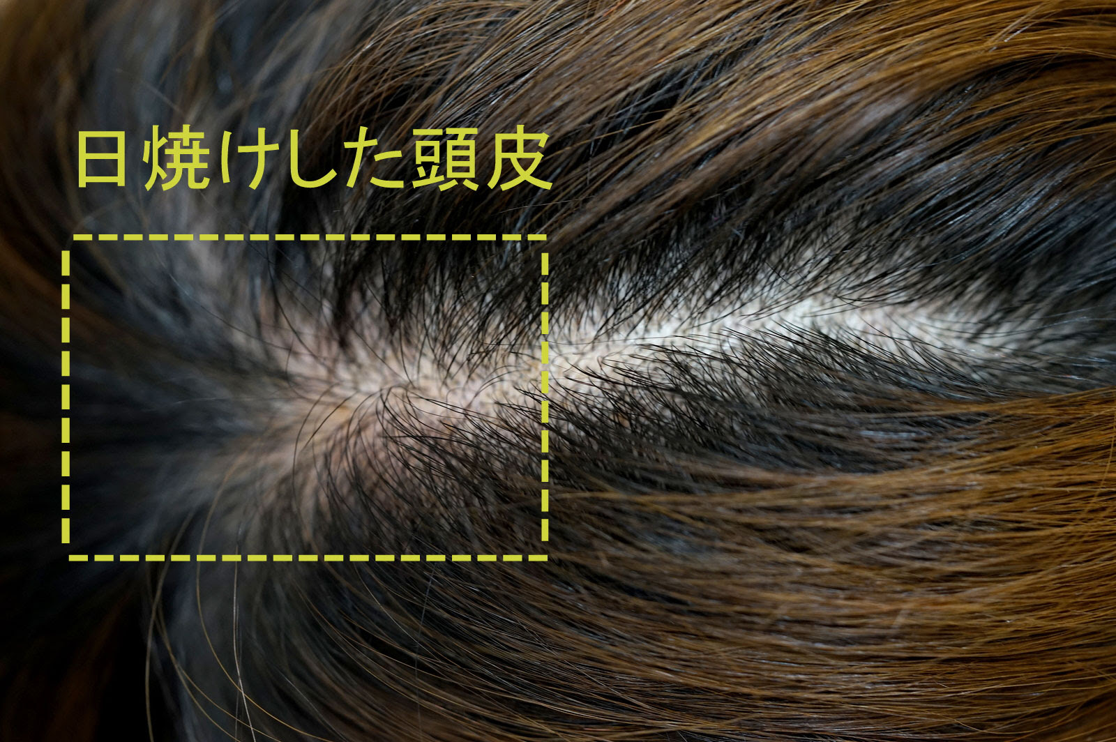 日焼けした頭皮は早めに対処 スキャルプケア編
