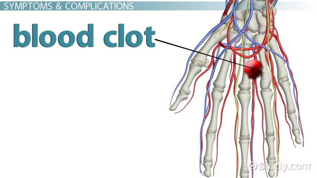 Blood Clot in the Hand: Symptoms, Signs & Treatment - Video & Lesson