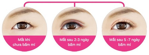 bấm mí có để lại sẹo không1