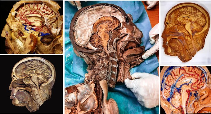  A Real Dissection of the Human brain