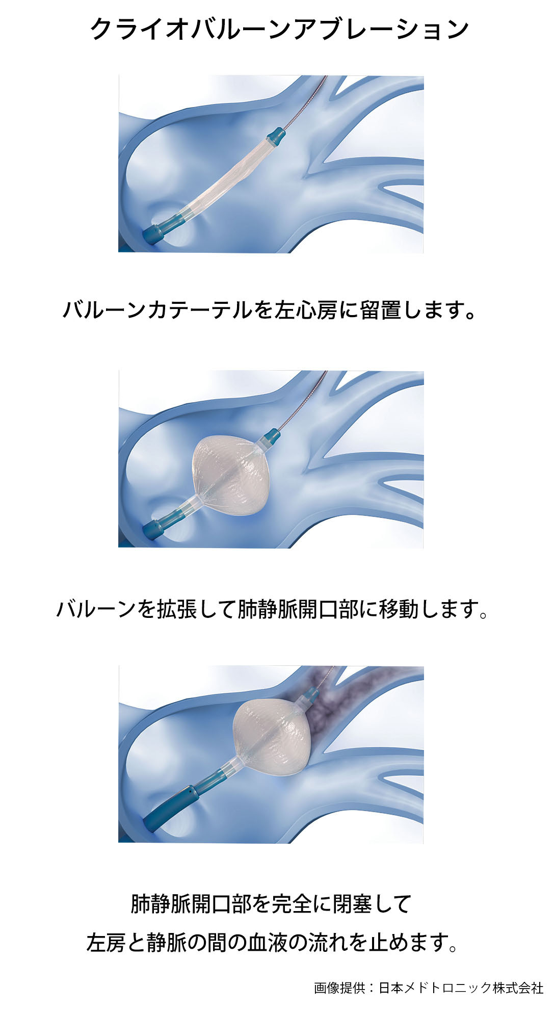 不整脈の治療 夛田浩