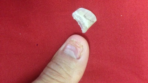 爪が剥がれた Mr Apatchブログ