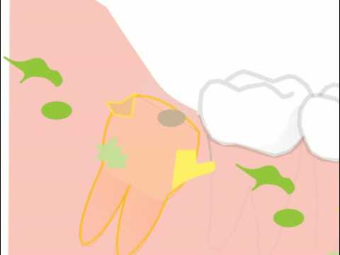 a impacted wisdom tooth?
