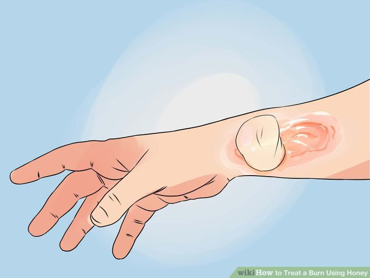 Treat a Burn Using Honey Step 12.jpg