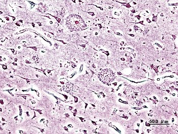 English: Histopathogic image of senile plaques...