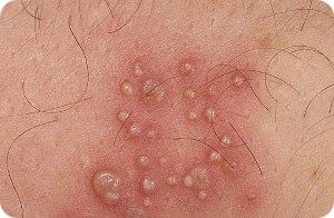 Does Get Rid of Herpes Work