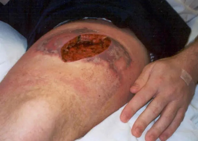 Picture 13: Spider bite, rown brown widow spider bites pictures. Picture 13: Spider bite, rown