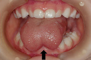 舌小帯短縮症 つれ舌 国立病院機構岡山医療センター 小児外科