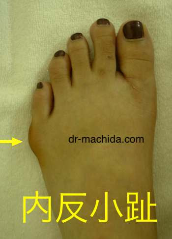 内反小趾に関する質問集