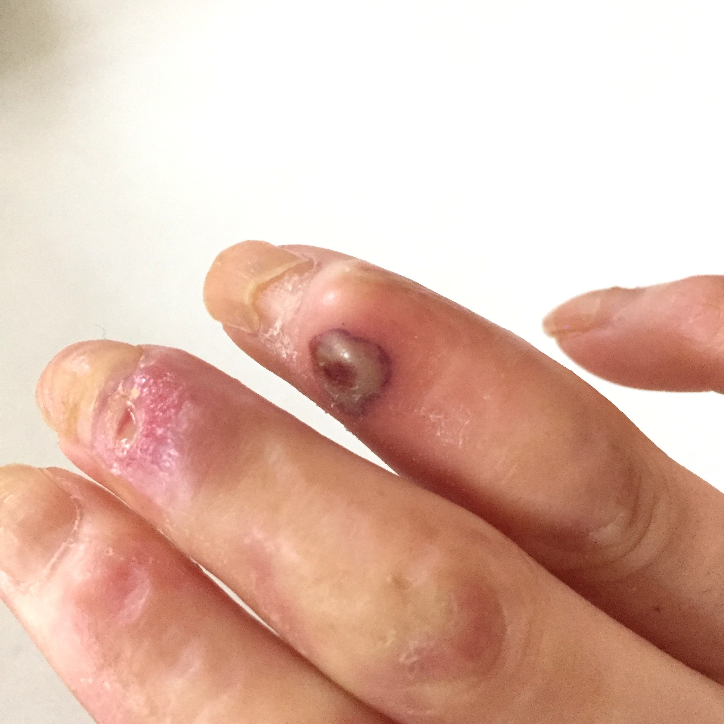 膠原病の主婦のささやかな幸せ 皮膚症状