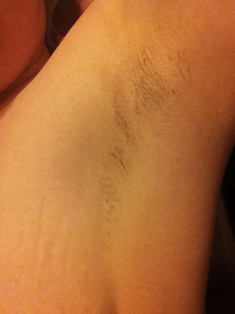 Laser Hair Removal Quad Cities Serenity Salon Day Spa