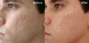 Home Remedies for Acne Overnight - Baking Soda Acne Before and After