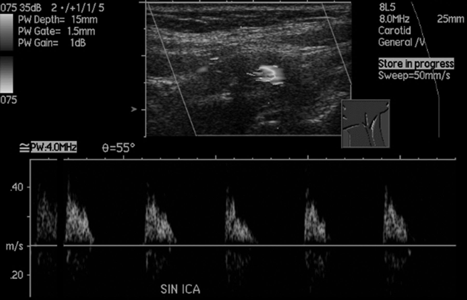 Carotid Near Occlusion A Comprehensive Review Part 1 Definition Terminology And Diagnosis American Journal Of Neuroradiology
