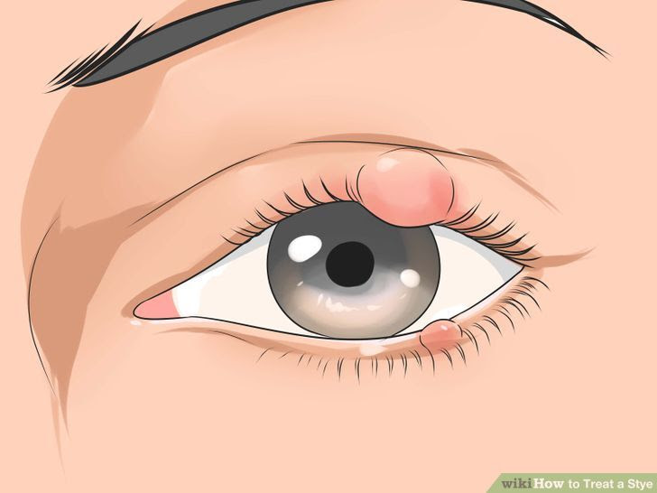Treat a Stye Step 1 Version 3.jpg