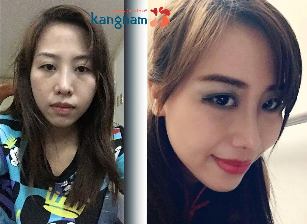 phau-thuat-lech-veo-vach-ngan-bao-nhieu-tien