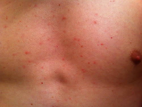 Bumps on Chest: Small, Re Remedies and Treatments
