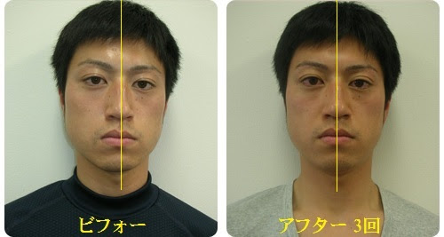 小顔矯正 顔の歪み矯正 ビフォーアフター画像 動画 体験談 関西プロポーション小顔センター大阪梅田院