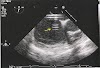 Pleural Mesothelioma What Is It - Mesothelioma Bilateral Pleural Effusion / Pleural Mesothelioma Causes