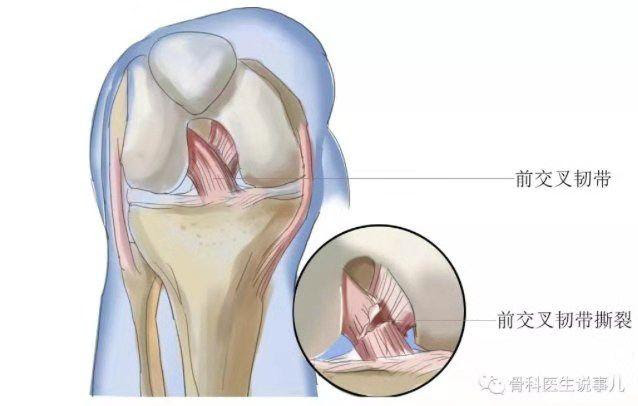北亚健康科普 前交叉韧带损伤的那些事 中国医疗