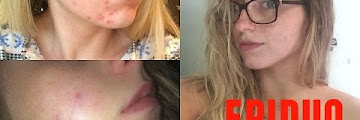 The Best 10 Epiduo Cream Before And After