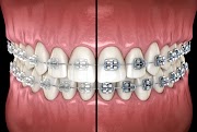 Ceramic Braces Info Keramik Spesial!
