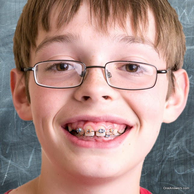 boy_braces_blue_orange_bands