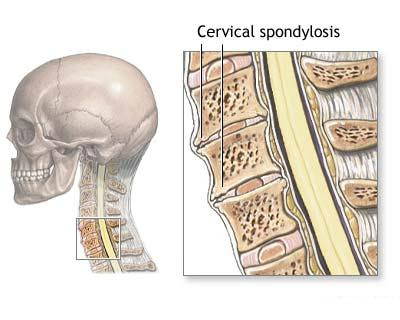 Best Natural Cervical Spondylosis Treatment