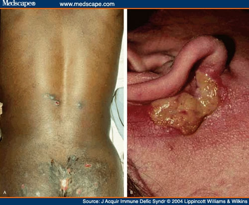 herpes simplex. Herpes Simplex Virus-2 and