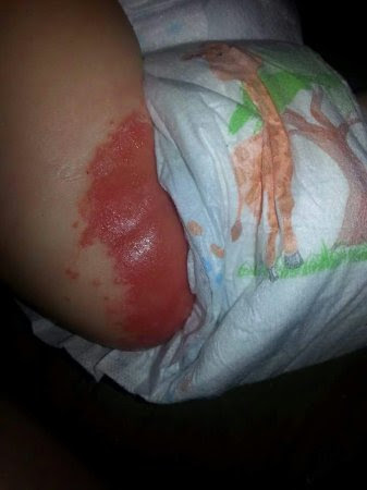 Chemical Burns From Huggies Pics Included Babycenter