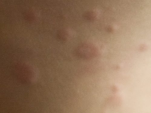 Bed Bug Bite Rash